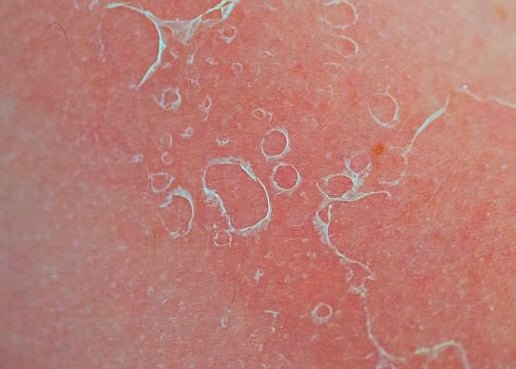 Why Is My Skin Peeling After Skincare? Causes & Remedies - Amala